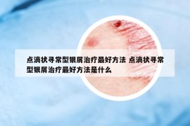 點滴狀尋常型銀屑治療最好方法 點滴狀尋常型銀屑治療最好方法是什么
