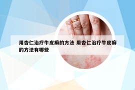 用杏仁治療牛皮癬的方法 用杏仁治療牛皮癬的方法有哪些