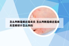 怎么判斷是癬還是皮炎 怎么判斷是癬還是皮炎苔癬狀什怎么樣的