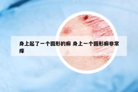身上起了一個(gè)圓形的癬 身上一個(gè)圓形癬非常癢