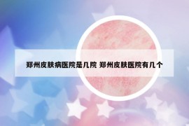 鄭州皮膚病醫(yī)院是幾院 鄭州皮膚醫(yī)院有幾個(gè)