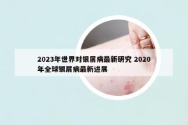 2023年世界對(duì)銀屑病最新研究 2020年全球銀屑病最新進(jìn)展