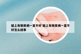 腿上有銀屑病一直不好 腿上有銀屑病一直不好怎么回事