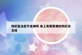 枸杞能治愈牛皮癬嗎 身上有銀屑病吃枸杞會怎樣