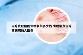 治療皮膚病的生物制劑多少錢 生物制劑治療皮膚病納入醫(yī)保