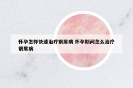 懷孕怎樣快速治療銀屑病 懷孕期間怎么治療銀屑病