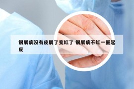 銀屑病沒有皮屑了變紅了 銀屑病不紅一圈起皮
