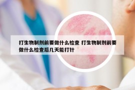 打生物制劑前要做什么檢查 打生物制劑前要做什么檢查后幾天能打針