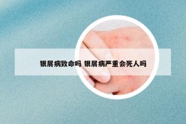 銀屑病致命嗎 銀屑病嚴(yán)重會(huì)死人嗎