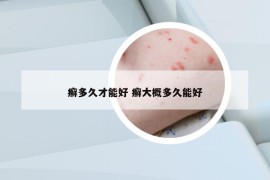 癬多久才能好 癬大概多久能好