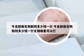 牛皮膚癬生物制劑多少錢一針 牛皮膚癬生物制劑多少錢一針無錫哪里可以打