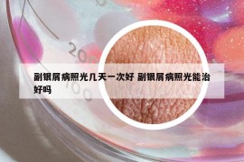 副銀屑病照光幾天一次好 副銀屑病照光能治好嗎