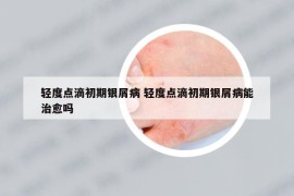 輕度點(diǎn)滴初期銀屑病 輕度點(diǎn)滴初期銀屑病能治愈嗎