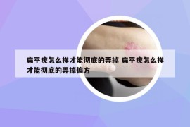 扁平疣怎么樣才能徹底的弄掉 扁平疣怎么樣才能徹底的弄掉偏方