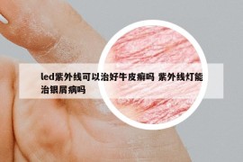 led紫外線可以治好牛皮癬嗎 紫外線燈能治銀屑病嗎
