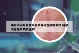哈爾濱治療女性銀屑病專科醫(yī)院哪家好 哈爾濱看銀屑病的醫(yī)院