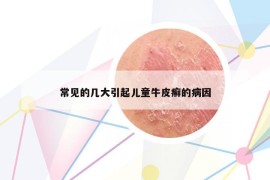 常見的幾大引起兒童牛皮癬的病因