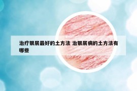 治療銀屑最好的土方法 治銀屑病的土方法有哪些