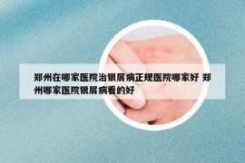 鄭州在哪家醫(yī)院治銀屑病正規(guī)醫(yī)院哪家好 鄭州哪家醫(yī)院銀屑病看的好