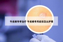 牛皮癬冬季治療 牛皮癬冬天應(yīng)該怎么護理