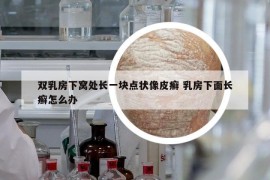 雙乳房下窩處長一塊點狀像皮癬 乳房下面長癬怎么辦