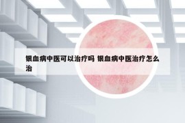 銀血病中醫(yī)可以治療嗎 銀血病中醫(yī)治療怎么治