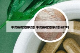 牛皮癬穩(wěn)定期狀態(tài) 牛皮癬穩(wěn)定期狀態(tài)會(huì)好嗎