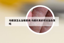烏根清怎么治銀屑病 烏根片真的可以治白發(fā)嗎