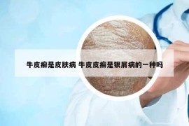 牛皮癬是皮膚病 牛皮皮癬是銀屑病的一種嗎