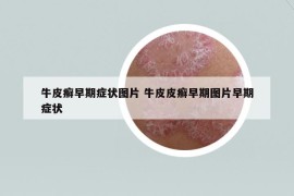 牛皮癬早期癥狀圖片 牛皮皮癬早期圖片早期癥狀