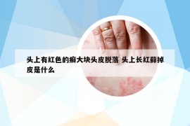 頭上有紅色的癬大塊頭皮脫落 頭上長(zhǎng)紅蘚掉皮是什么