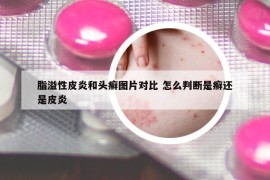 脂溢性皮炎和頭癬圖片對比 怎么判斷是癬還是皮炎