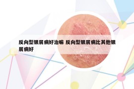 反向型銀屑病好治嘛 反向型銀屑病比其他銀屑病好