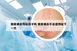 銀屑病會傳給孩子嗎 銀屑病會不會遺傳給下一代