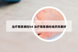 治療銀屑病吃k4 治療銀屑病吃啥藥效果好