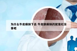 為什么牛皮癬抹下去 牛皮膚癬抹藥就變紅沒事吧
