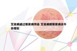 艾滋病通過銀屑病傳染 艾滋病跟銀屑病會不會相似