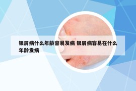 銀屑病什么年齡容易發(fā)病 銀屑病容易在什么年齡發(fā)病