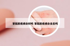 掌跖膿皰病會好嗎 掌跖膿皰病會自愈嗎