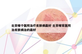 北京哪個醫(yī)院治療皮膚病最好 北京哪家醫(yī)院治皮膚病治的最好