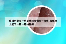 胳膊肘上有一塊皮膚粗糙像癬一樣疼 胳膊肘上起了一片一片的像癬