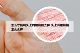 怎么才能叫頭上的銀屑病去掉 頭上有銀屑病怎么止癢