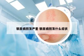 銀屑病初發(fā)嚴(yán)重 銀屑病初發(fā)什么癥狀
