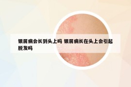 銀屑病會(huì)長(zhǎng)到頭上嗎 銀屑病長(zhǎng)在頭上會(huì)引起脫發(fā)嗎