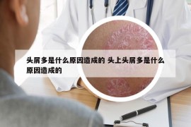 頭屑多是什么原因造成的 頭上頭屑多是什么原因造成的