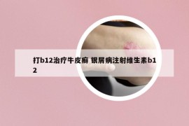 打b12治療牛皮癬 銀屑病注射維生素b12
