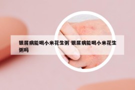 銀屑病能喝小米花生粥 銀屑病能喝小米花生粥嗎