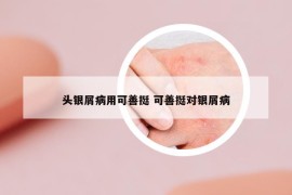 頭銀屑病用可善挺 可善挺對銀屑病