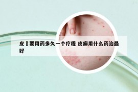 皮廯要用藥多久一個療程 皮癬用什么藥治最好
