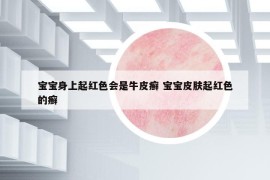 寶寶身上起紅色會是牛皮癬 寶寶皮膚起紅色的癬
